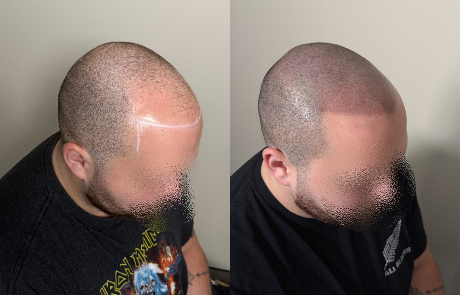 Shaved look SMP portfolio 6